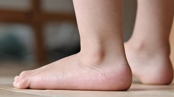 Bàn chân bẹt có nguy hiểm không?