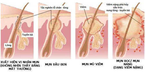 Khắc phục nỗi lo về mụn với công nghệ laser RF