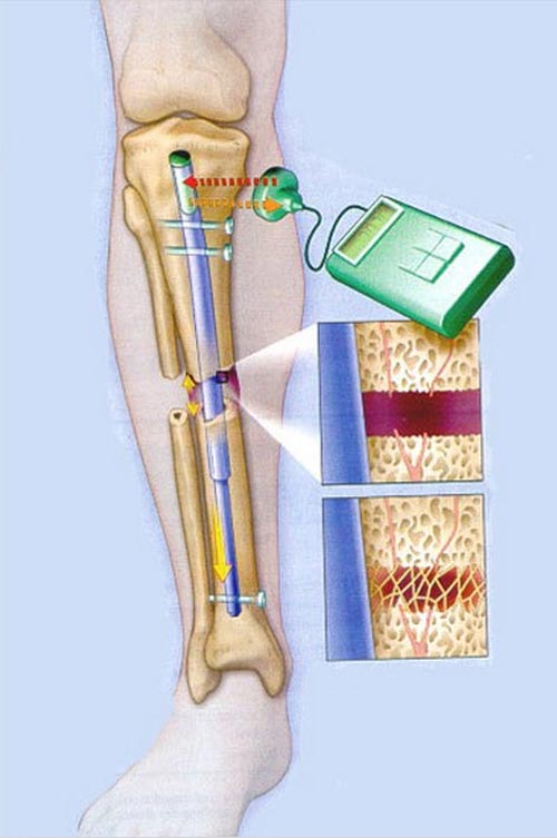 Kinh hoàng với mốt phẫu thuật kéo dài chân - 3