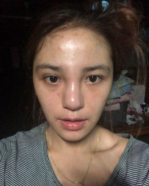 Cô gái suýt phải cắt bỏ mũi vì phẫu thuật thẩm mỹ hỏng - 6