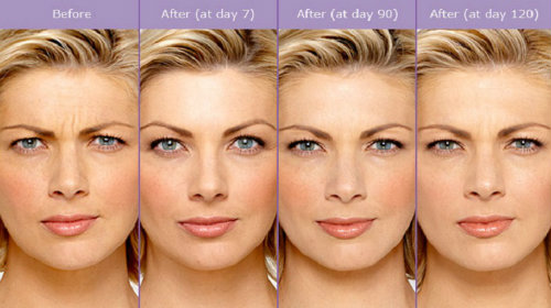 Những lý do để nói không với botox - 10