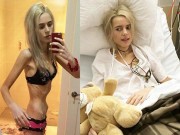 Làm đẹp - Cô gái 19 tuổi suýt chết vì nhịn ăn giảm cân